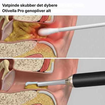 Otivella™ Pro | Den første visuelle ørerens med SmartSigt™-teknologi